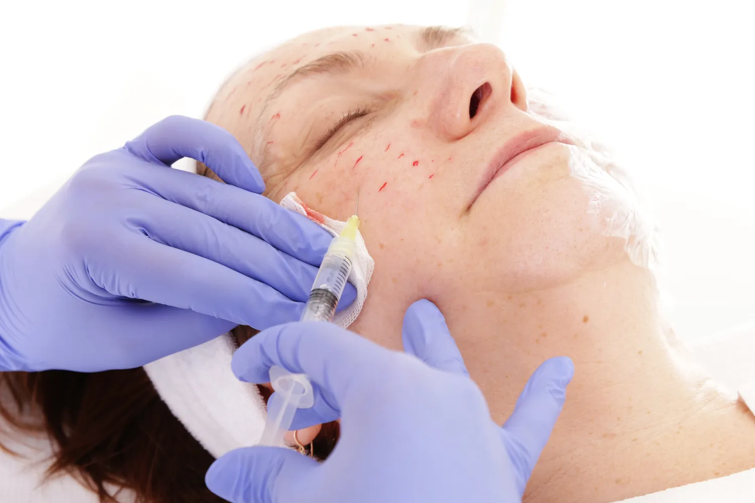 Mezoterapia igłowa w Lublinie