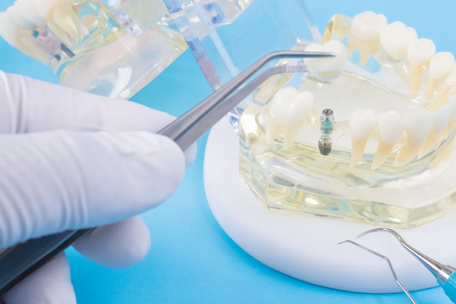 Jak wygląda leczenie kanałowe zęba?